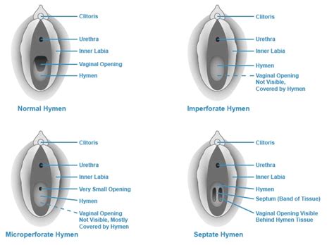 Virginity + Hymen types and causes of Hymen rupture